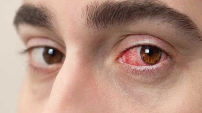 Alertan sobre incremento de alergias oculares en Aragua